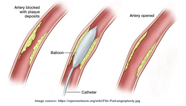 Figure 6: Drug-Coated Balloon Angioplasty process